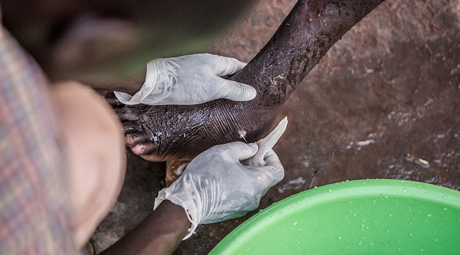 A Guinea worm is slowly and carefully extracted from the foot of a person at a case containment center where patients receive care in Wau, South Sudan. 
