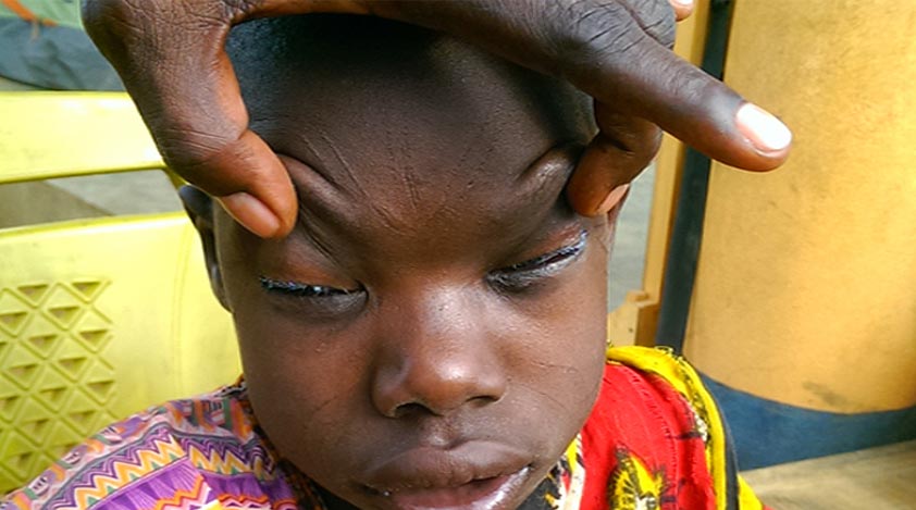 A close-up photo of Lochin's eyelids before surgery